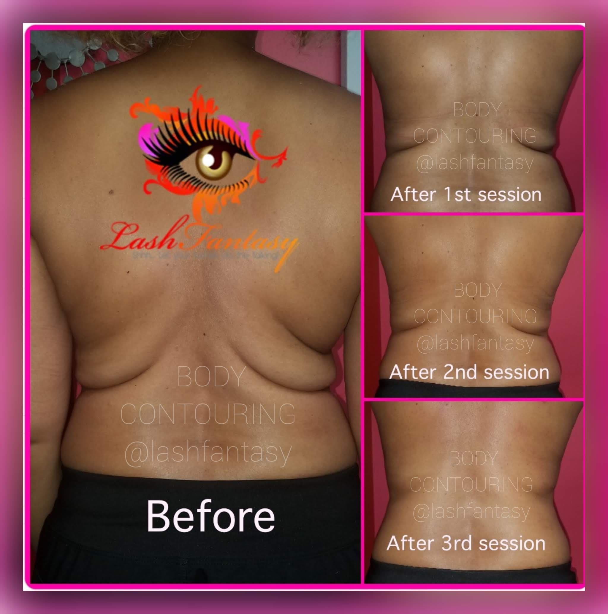 Bodcor Body Contouring for Back of Legs